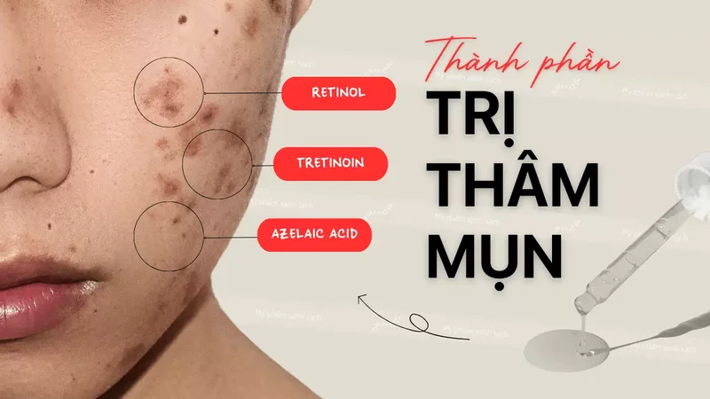 Những vấn đề hay gặp về các sản phẩm trị thâm mụn tốt nhất hiện nay