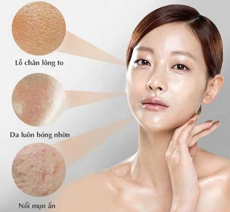 Tại sao cần sử dụng các loại kem chống năng đặc biệt khi bị da dầu mụn