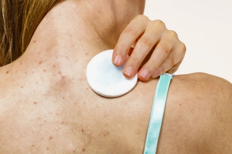 Xà phòng trị mụn lưng Dove Men+Care