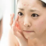 Quy trình thực hiện sử dụng sản phẩm trị thâm mụn tốt nhất hiện nay