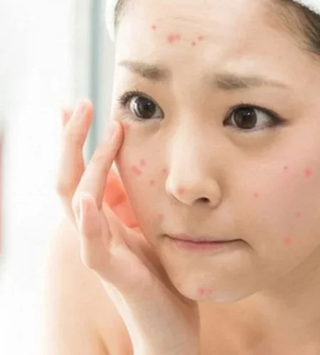 Quy trình thực hiện sử dụng sản phẩm trị thâm mụn tốt nhất hiện nay