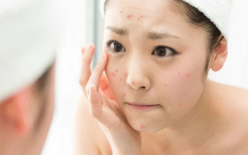 Quy trình thực hiện sử dụng sản phẩm trị thâm mụn tốt nhất hiện nay